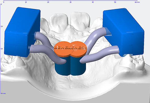 3D Design einer Bohrschablone für eine skelettale Verankerung, Implantat